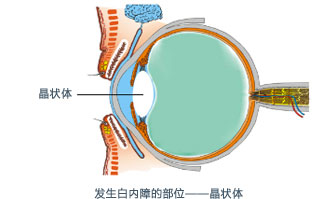 什么是白内障
