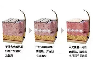 水光治疗  