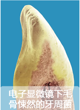 电子显微镜下毛骨悚然的牙周菌